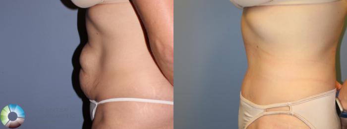 Before & After Tummy Tuck Case 11381 Left Side in Denver and Colorado Springs, CO