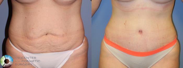 Before & After Tummy Tuck Case 11382 Front in Denver and Colorado Springs, CO