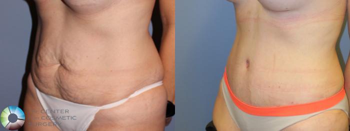 Before & After Tummy Tuck Case 11382 Left Oblique in Denver and Colorado Springs, CO