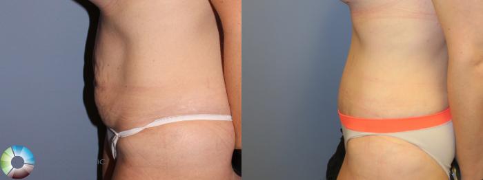 Before & After Tummy Tuck Case 11382 Left Side in Denver and Colorado Springs, CO