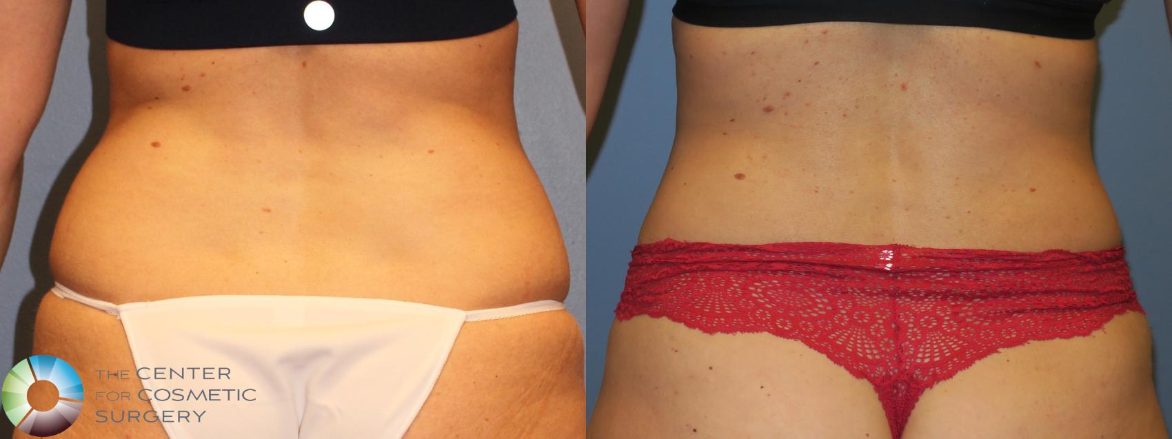 Before & After Tummy Tuck Case 11383 Back in Denver and Colorado Springs, CO