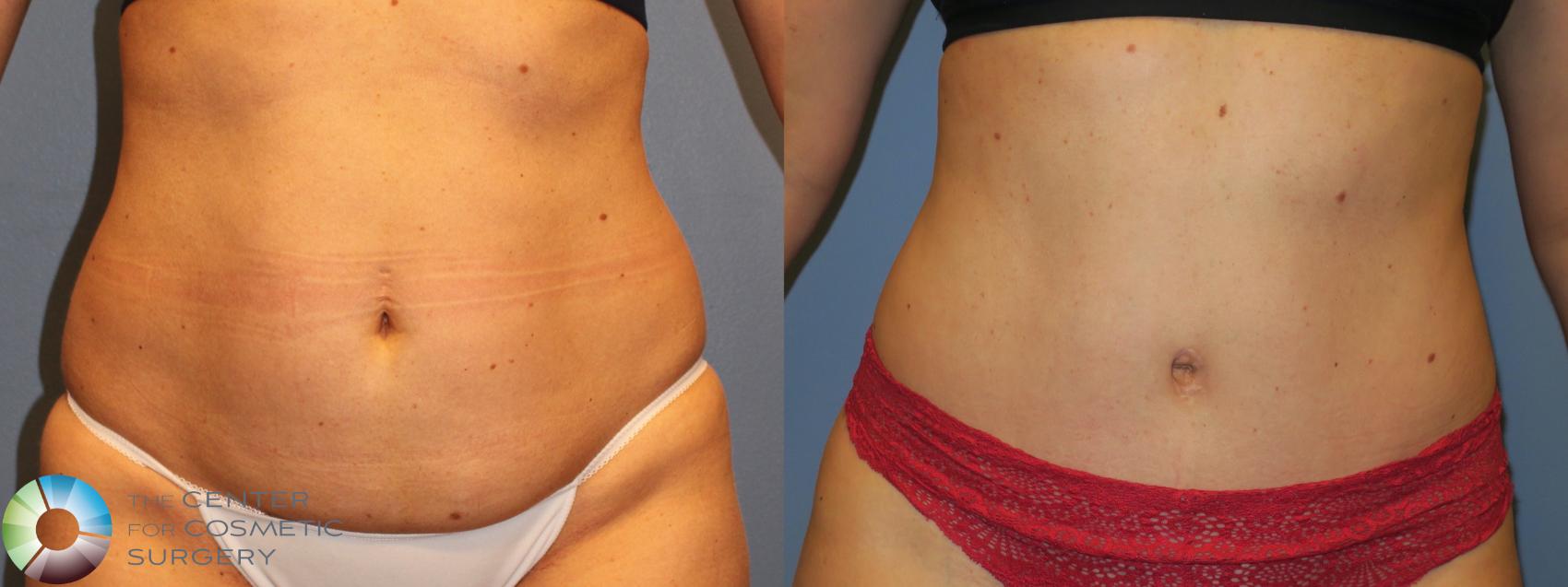 Before & After Tummy Tuck Case 11383 Front in Denver and Colorado Springs, CO