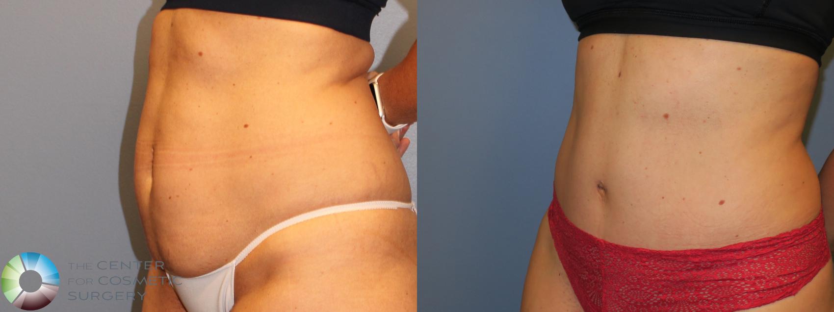 Before & After Tummy Tuck Case 11383 Left Oblique in Denver and Colorado Springs, CO