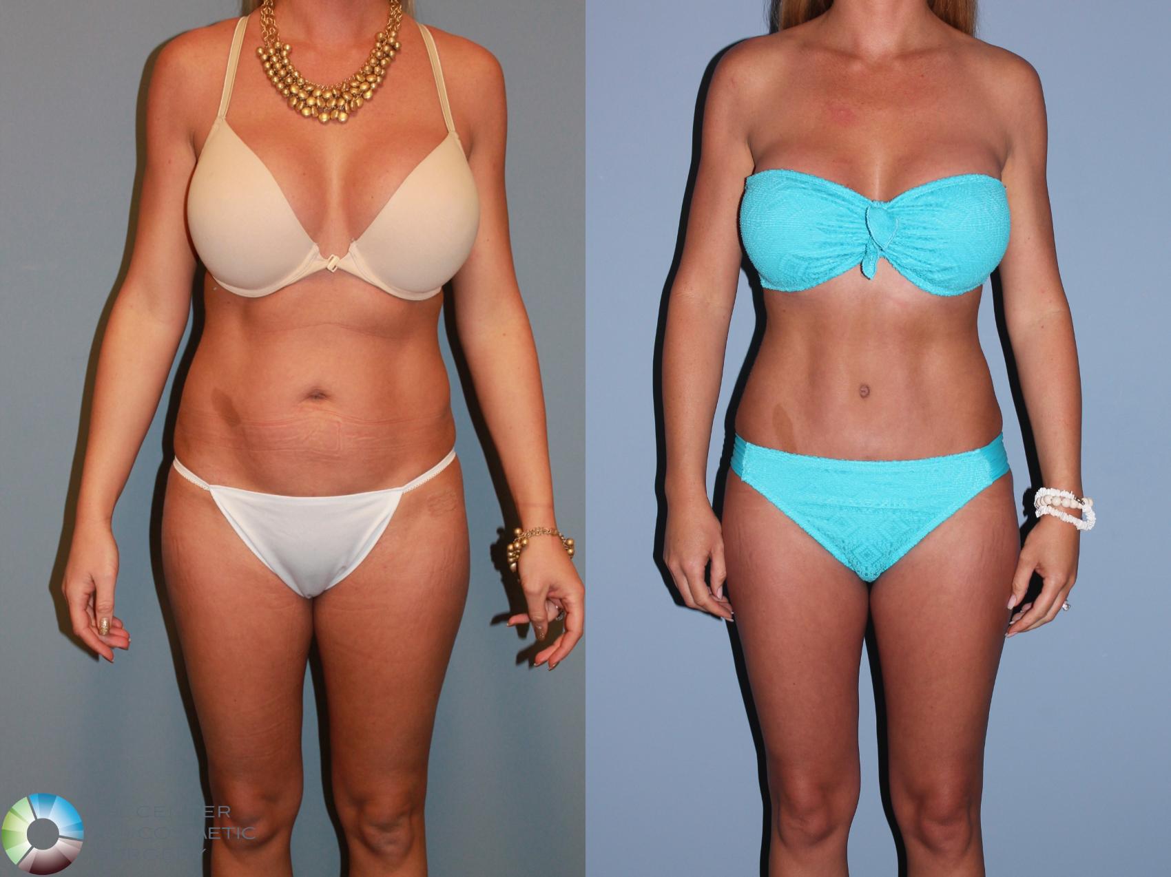 Before & After Tummy Tuck Case 11387 Front in Denver and Colorado Springs, CO