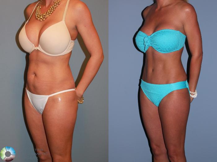 Before & After Tummy Tuck Case 11387 Left Oblique View in Golden, CO
