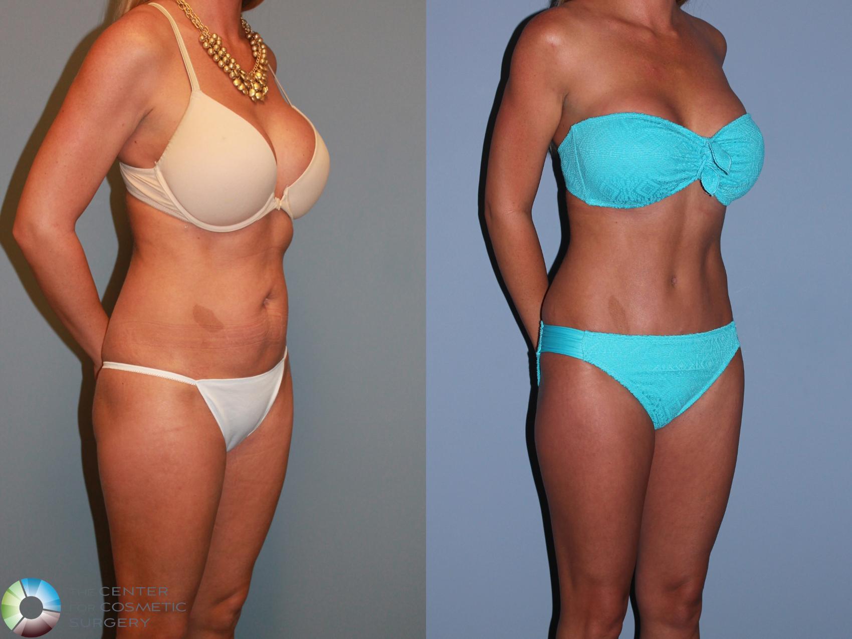 Before & After Tummy Tuck Case 11387 Right Oblique in Denver and Colorado Springs, CO