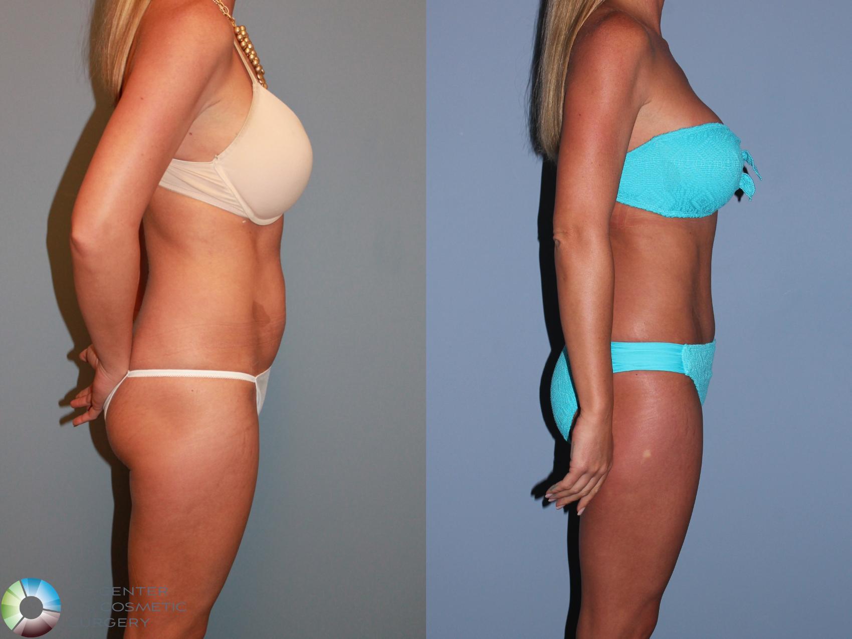 Before & After Tummy Tuck Case 11387 Right Side in Denver and Colorado Springs, CO