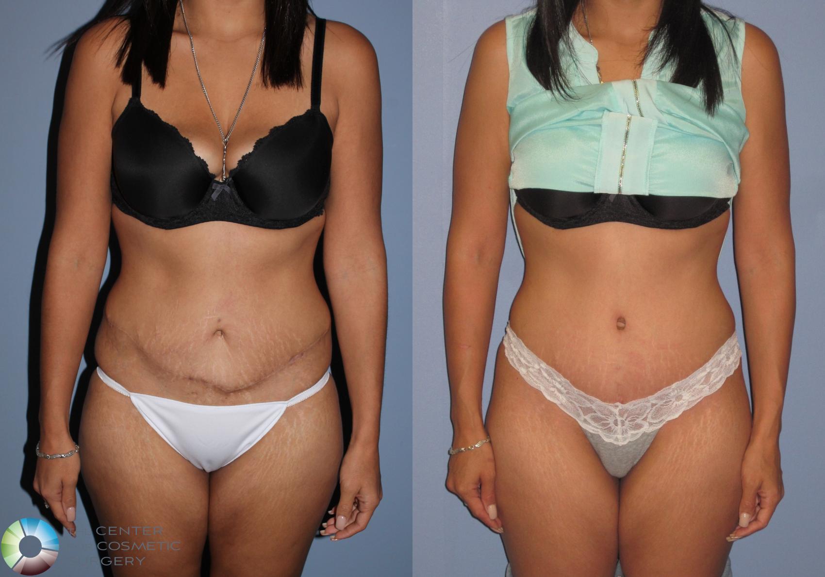 Before & After Tummy Tuck Case 11390 Front View in Golden, CO