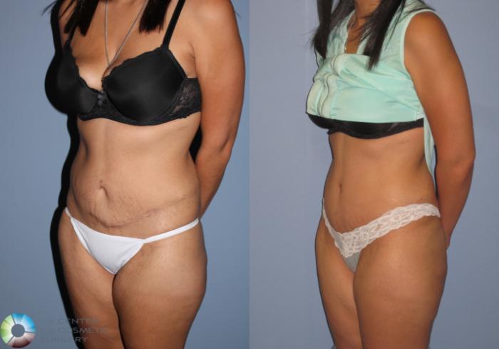 Before & After Tummy Tuck Case 11390 Left Oblique View in Golden, CO