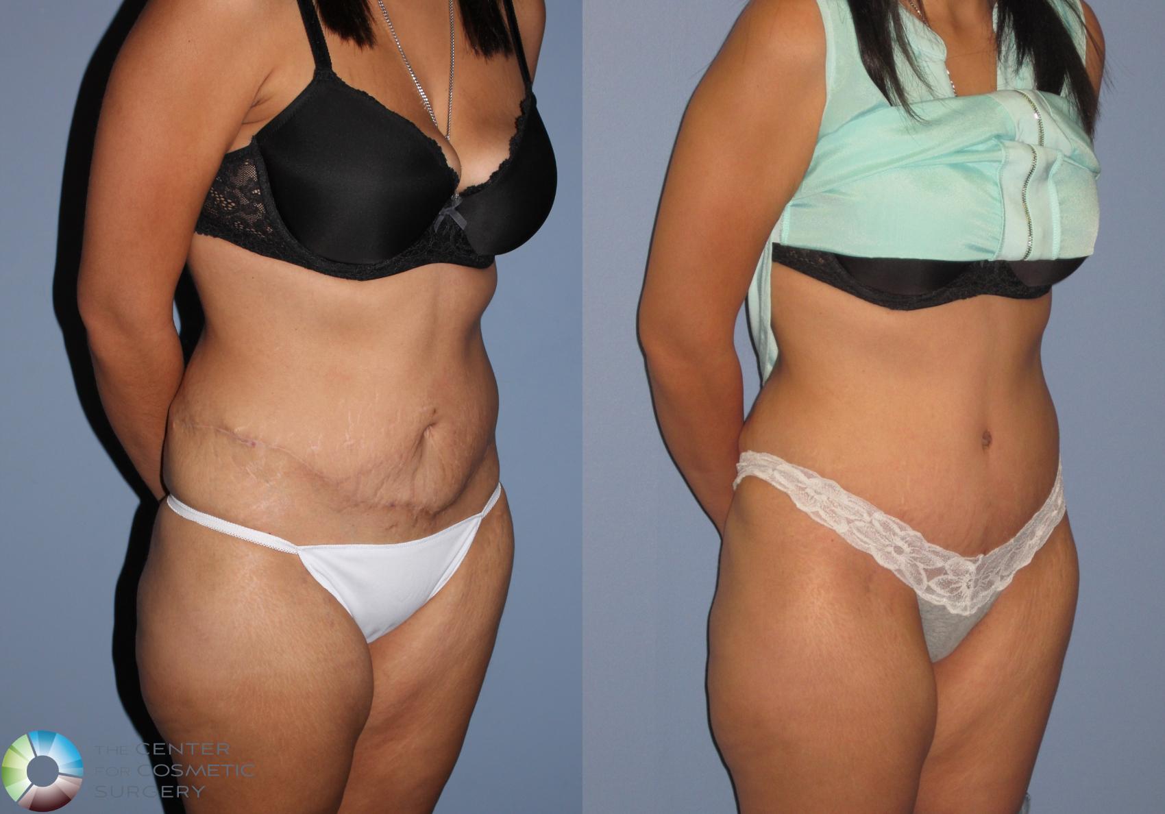 Before & After Tummy Tuck Case 11390 Right Oblique View in Golden, CO