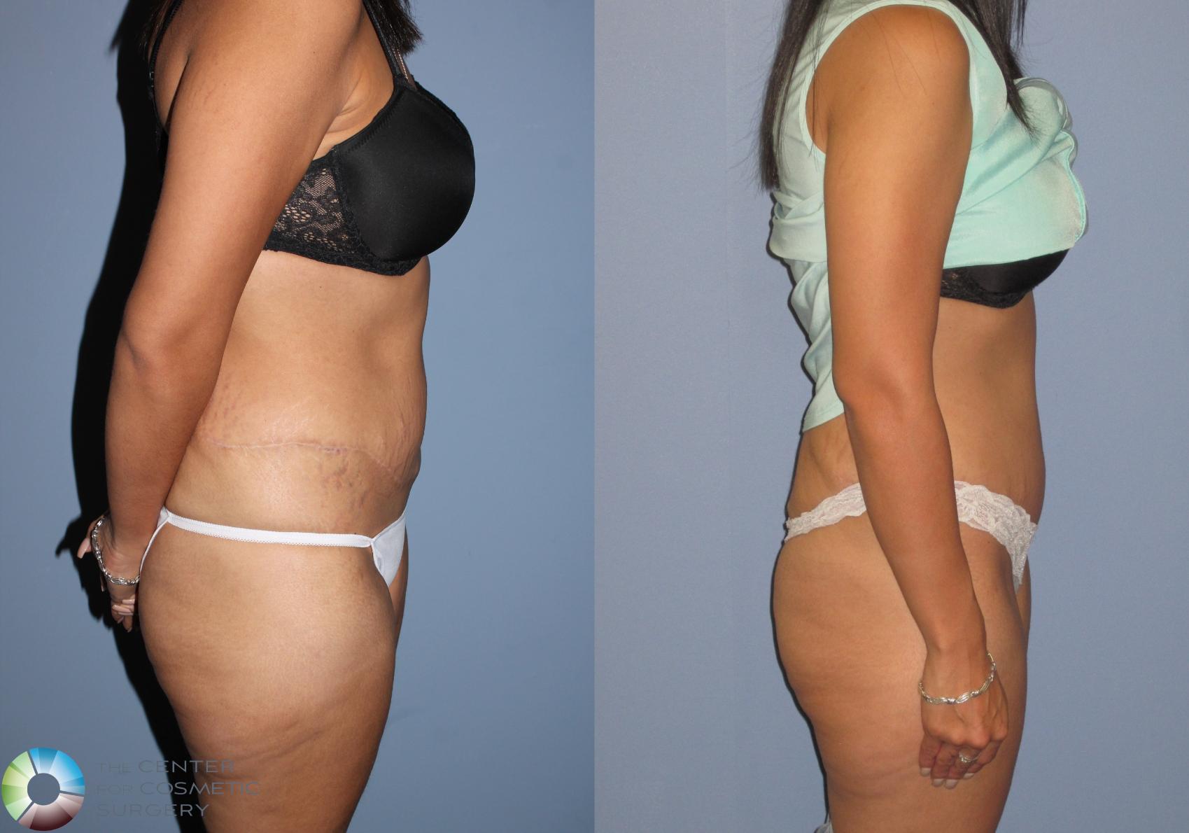 Before & After Tummy Tuck Case 11390 Right Side View in Golden, CO