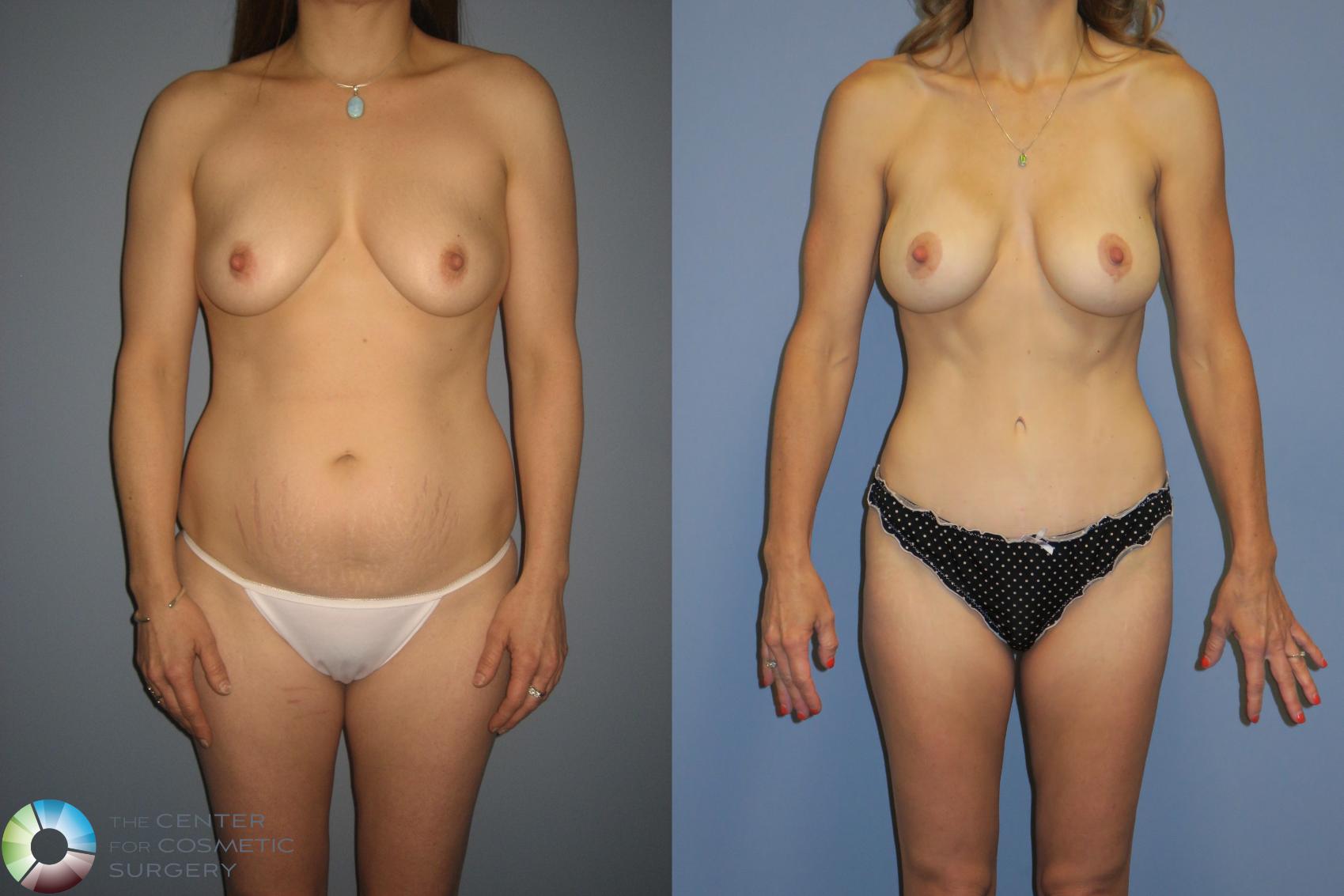 Before & After Tummy Tuck Case 11391 Front View in Golden, CO