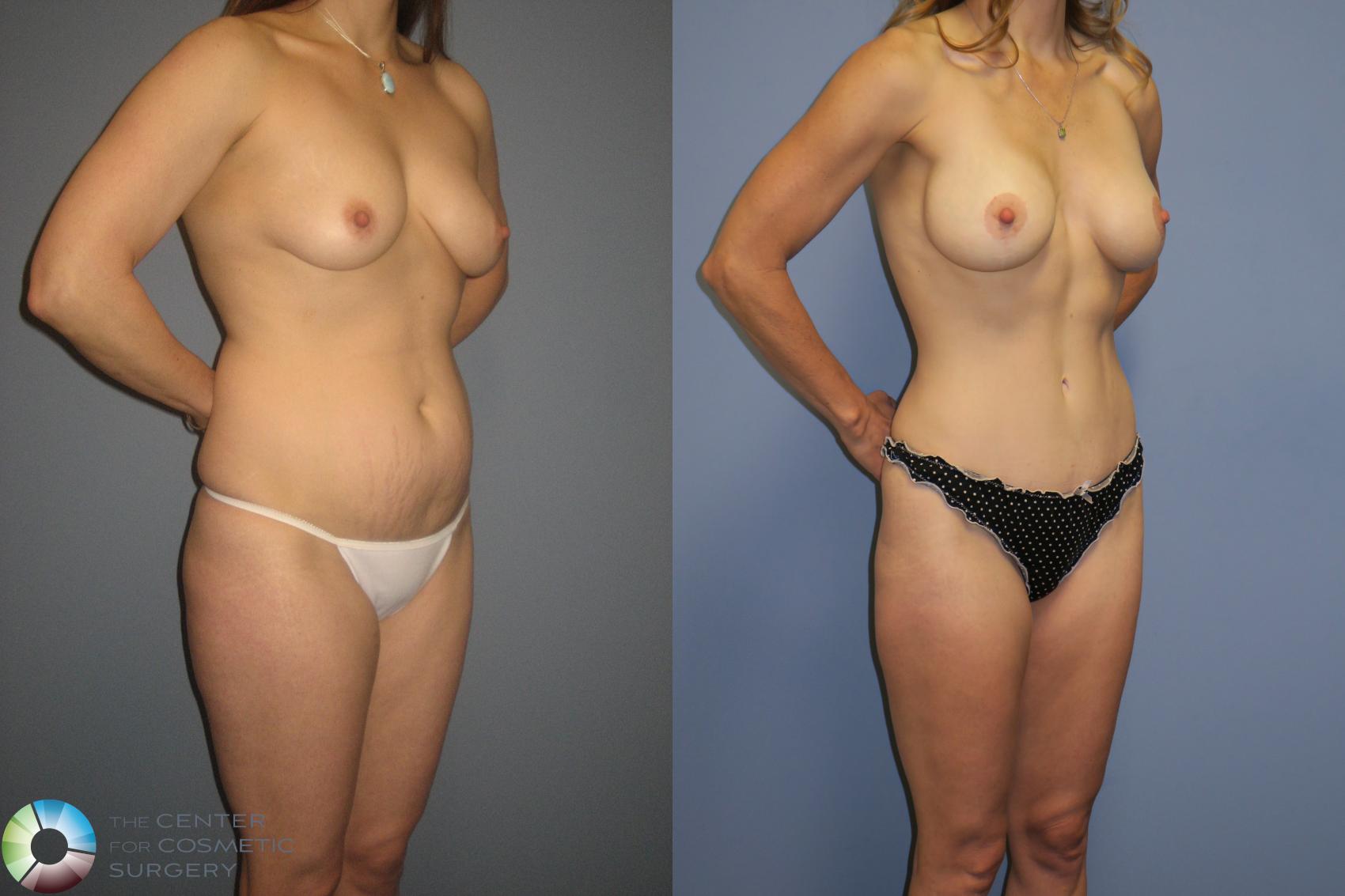 Before & After Tummy Tuck Case 11391 Left Oblique in Denver and Colorado Springs, CO