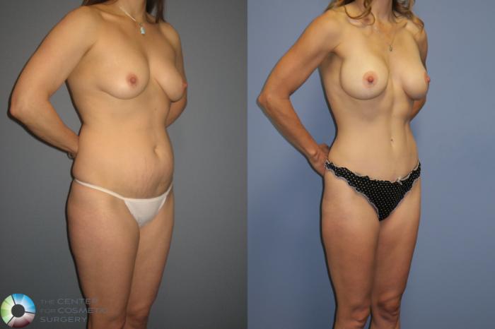 Before & After Tummy Tuck Case 11391 Left Oblique View in Golden, CO