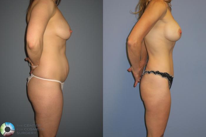 Before & After Tummy Tuck Case 11391 Right Side View in Golden, CO