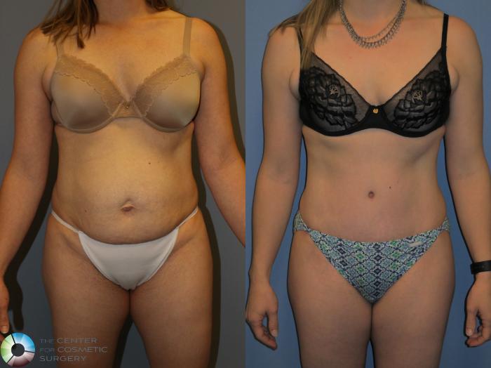Before & After Tummy Tuck Case 11392 Front in Denver and Colorado Springs, CO