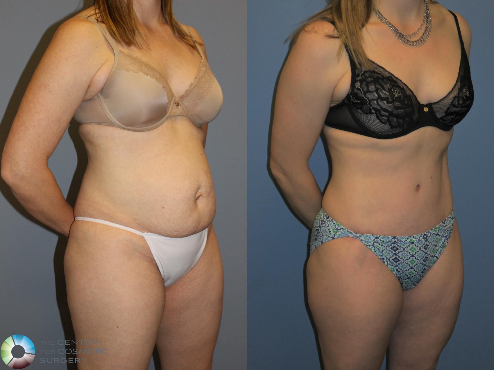 Before & After Tummy Tuck Case 11392 Right Oblique View in Denver & Golden, CO