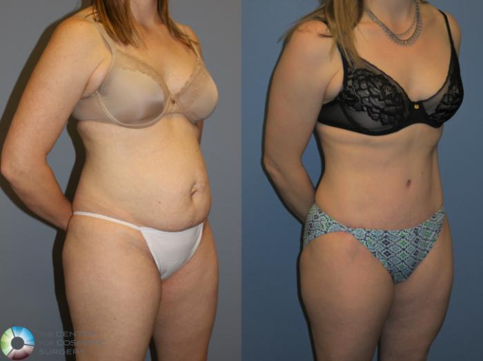 Before & After Tummy Tuck Case 11392 Right Oblique in Denver and Colorado Springs, CO