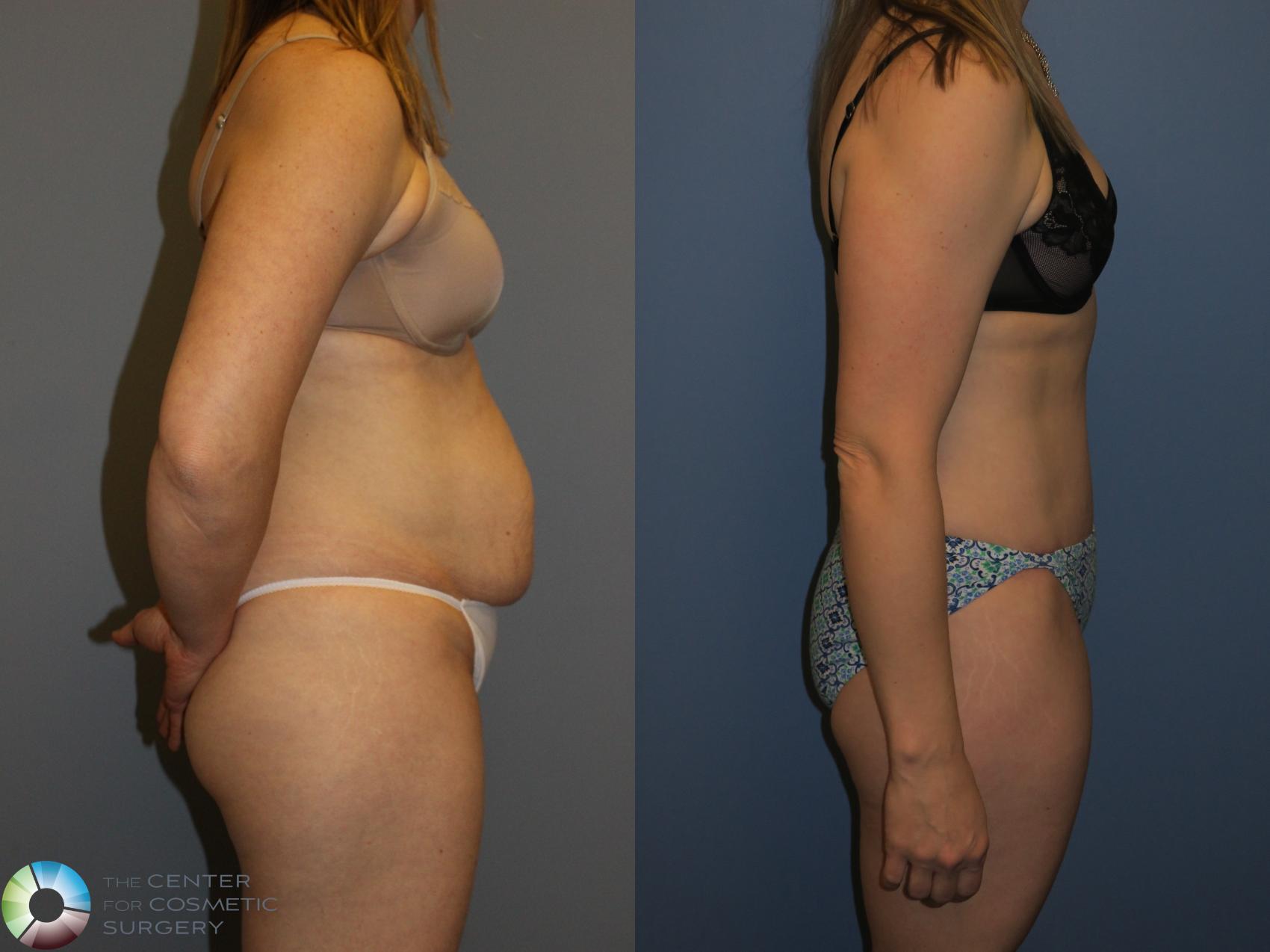 Before & After Tummy Tuck Case 11392 Right Side View in Golden, CO