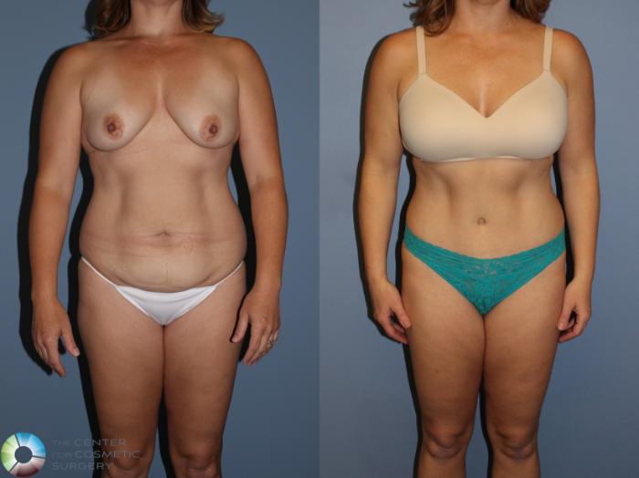 Before & After Tummy Tuck Case 11393 Front View in Golden, CO