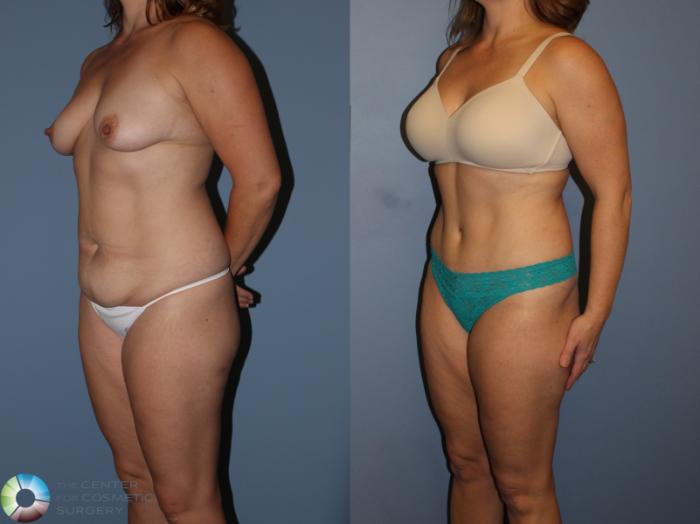 Before & After Tummy Tuck Case 11393 Left Oblique View in Golden, CO