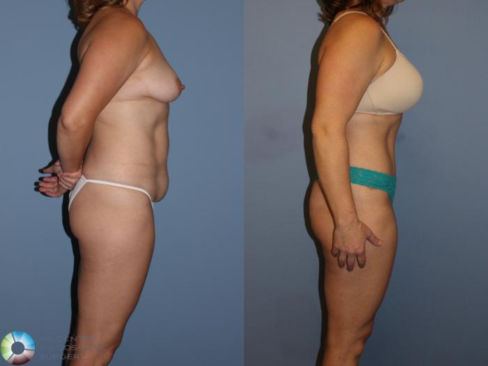 Before & After Tummy Tuck Case 11393 Right Side View in Golden, CO