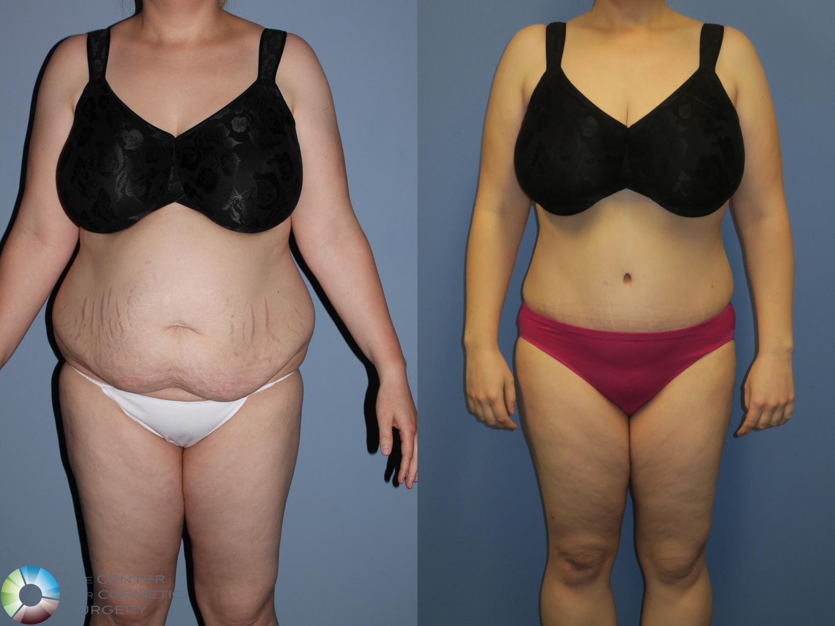 Tummy Tuck Before and After Pictures Case 11394, Denver, CO