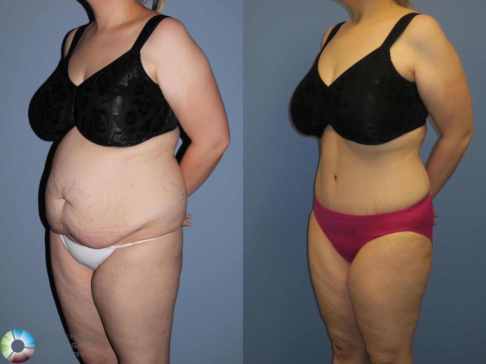 Before & After Power-assisted Liposuction Case 11394 Left Oblique View in Denver & Golden, CO