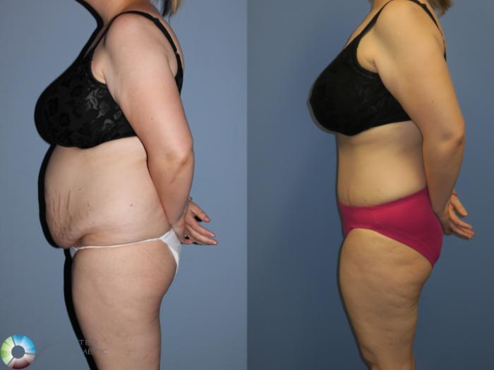Before & After Tummy Tuck Case 11394 Left Side View in Golden, CO