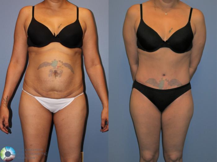Before & After Tummy Tuck Case 11395 Front View in Golden, CO