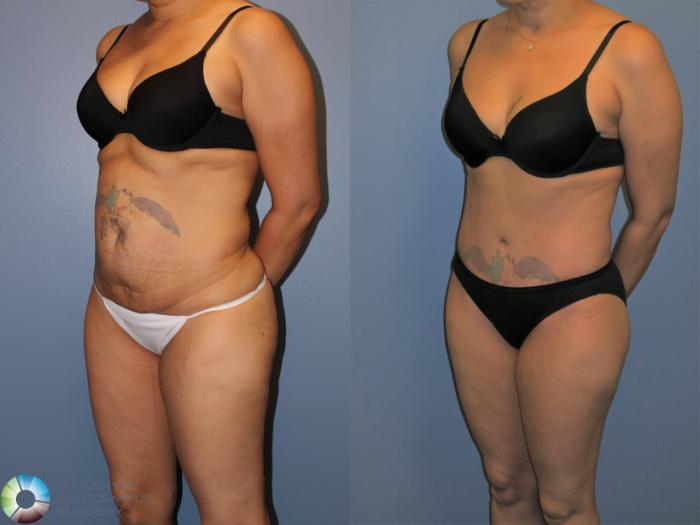 Before & After Tummy Tuck Case 11395 Left Oblique View in Golden, CO