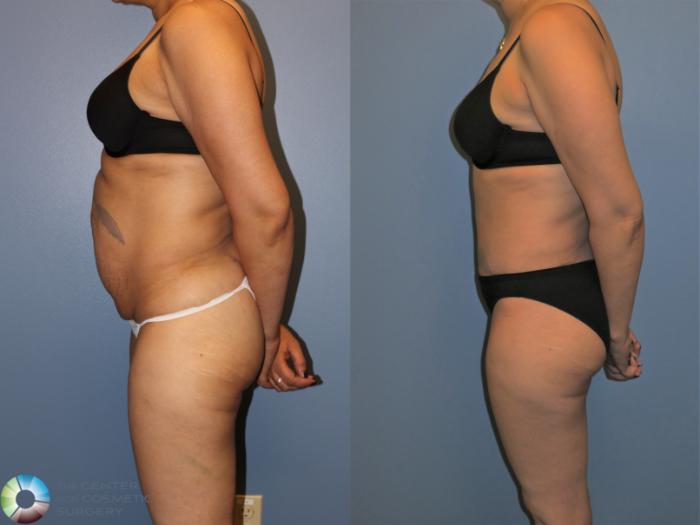 Before & After Tummy Tuck Case 11395 Left Side View in Golden, CO