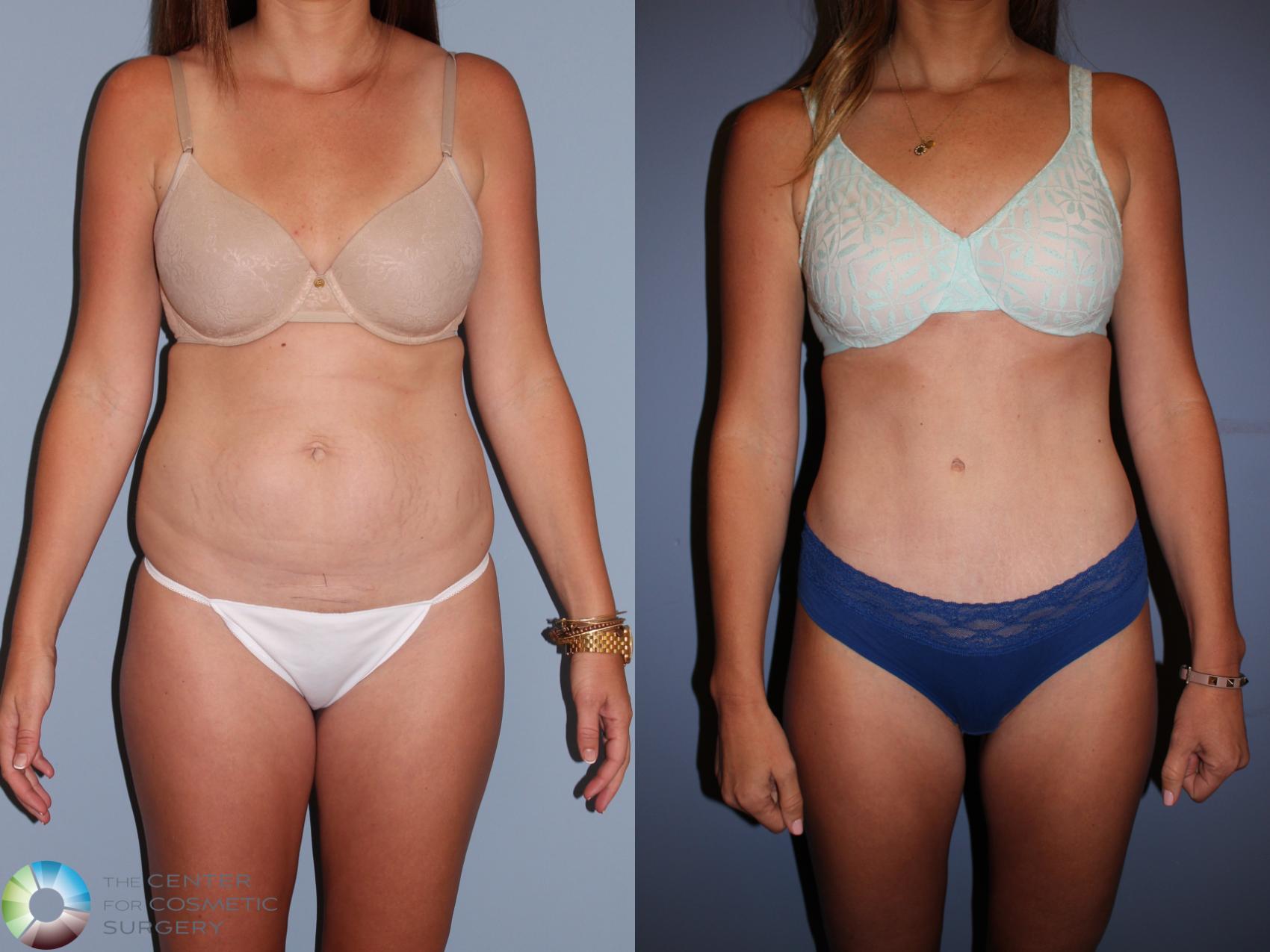Before & After Tummy Tuck Case 11396 Front View in Denver & Golden, CO