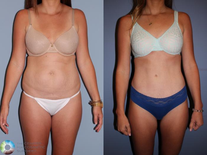 Before & After Tummy Tuck Case 11396 Front in Denver, CO