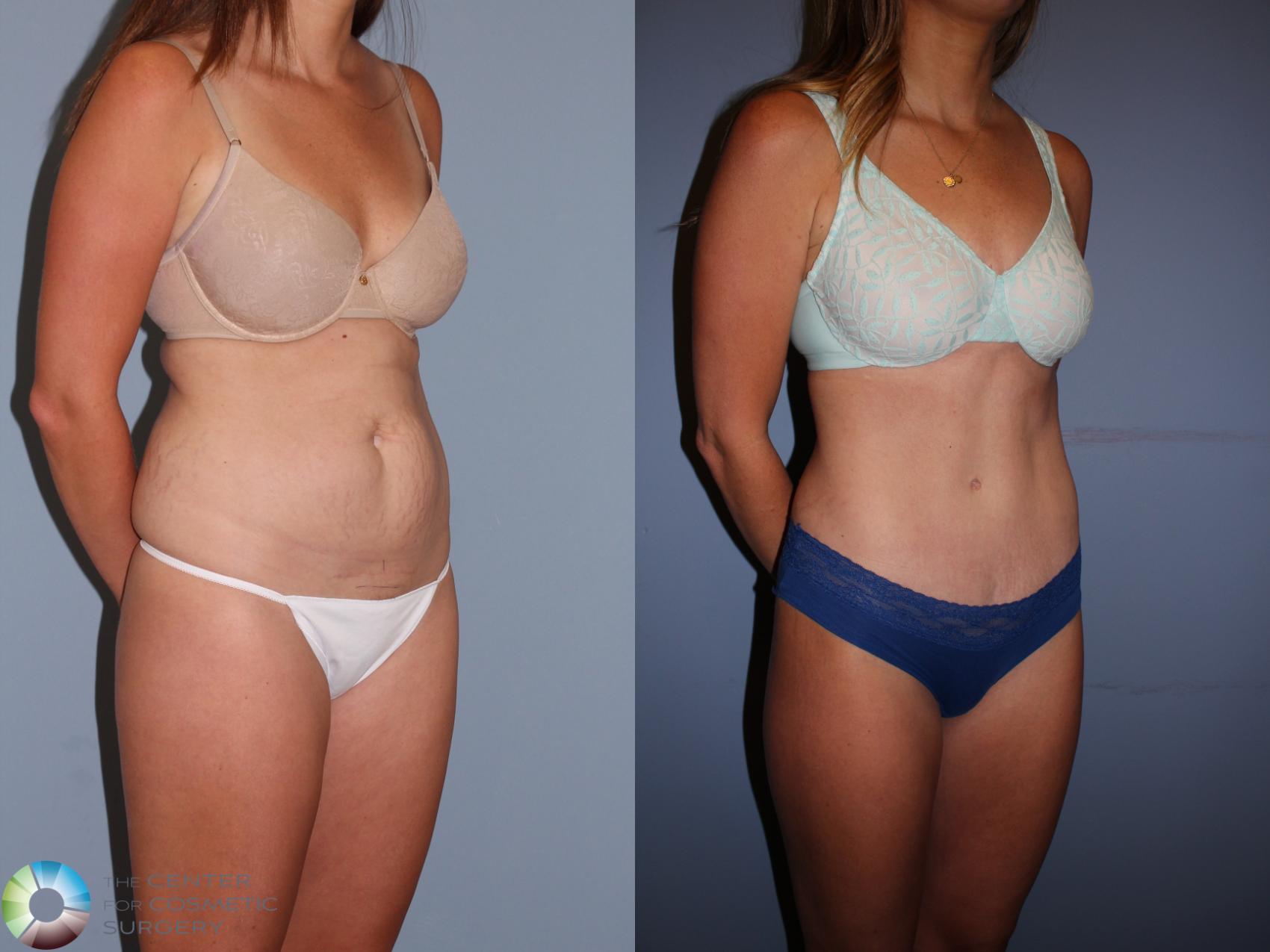 Before & After Tummy Tuck Case 11396 Right Oblique in Denver, CO