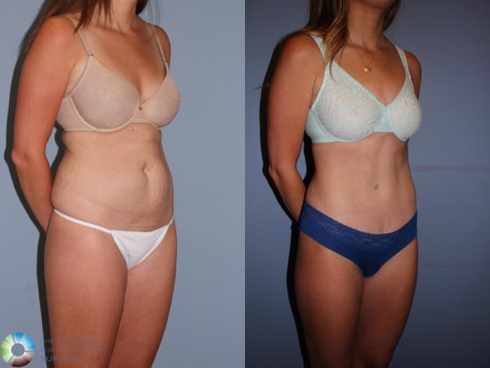 Before & After Tummy Tuck Case 11396 Right Oblique in Denver, CO
