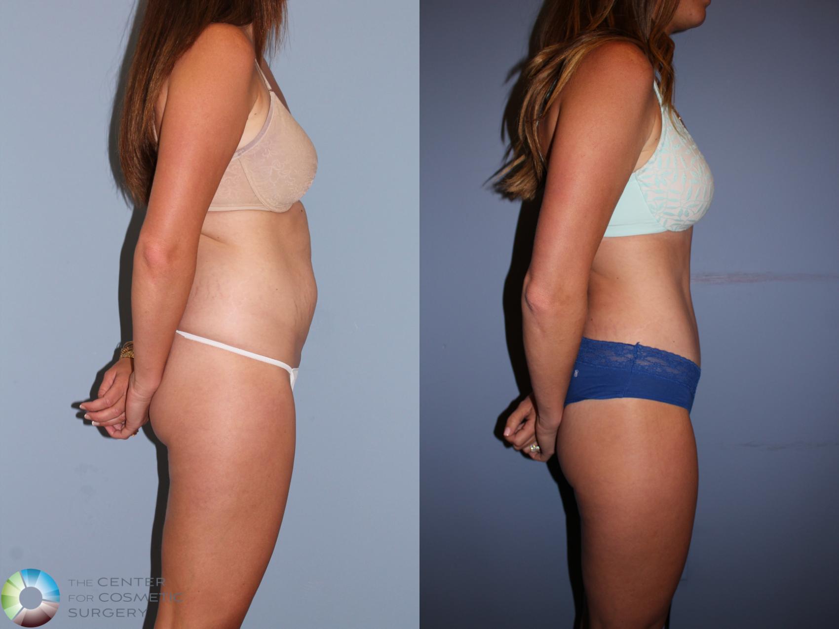 Before & After Tummy Tuck Case 11396 Right Side View in Denver & Golden, CO