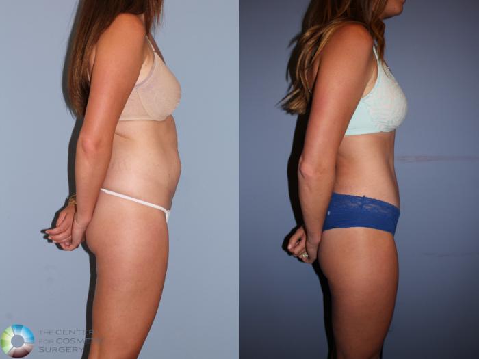 Before & After Tummy Tuck Case 11396 Right Side in Denver, CO