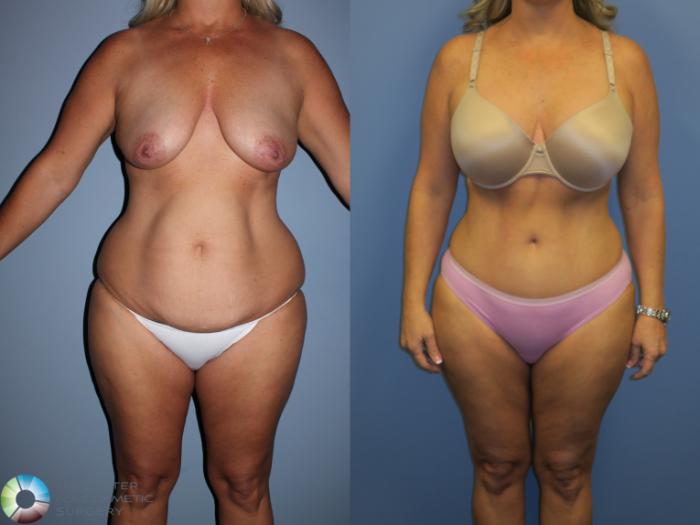 Before & After Tummy Tuck Case 11397 Front View in Golden, CO
