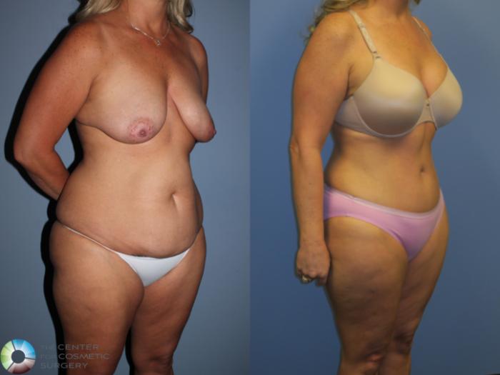 Before & After Tummy Tuck Case 11397 Right Oblique View in Golden, CO