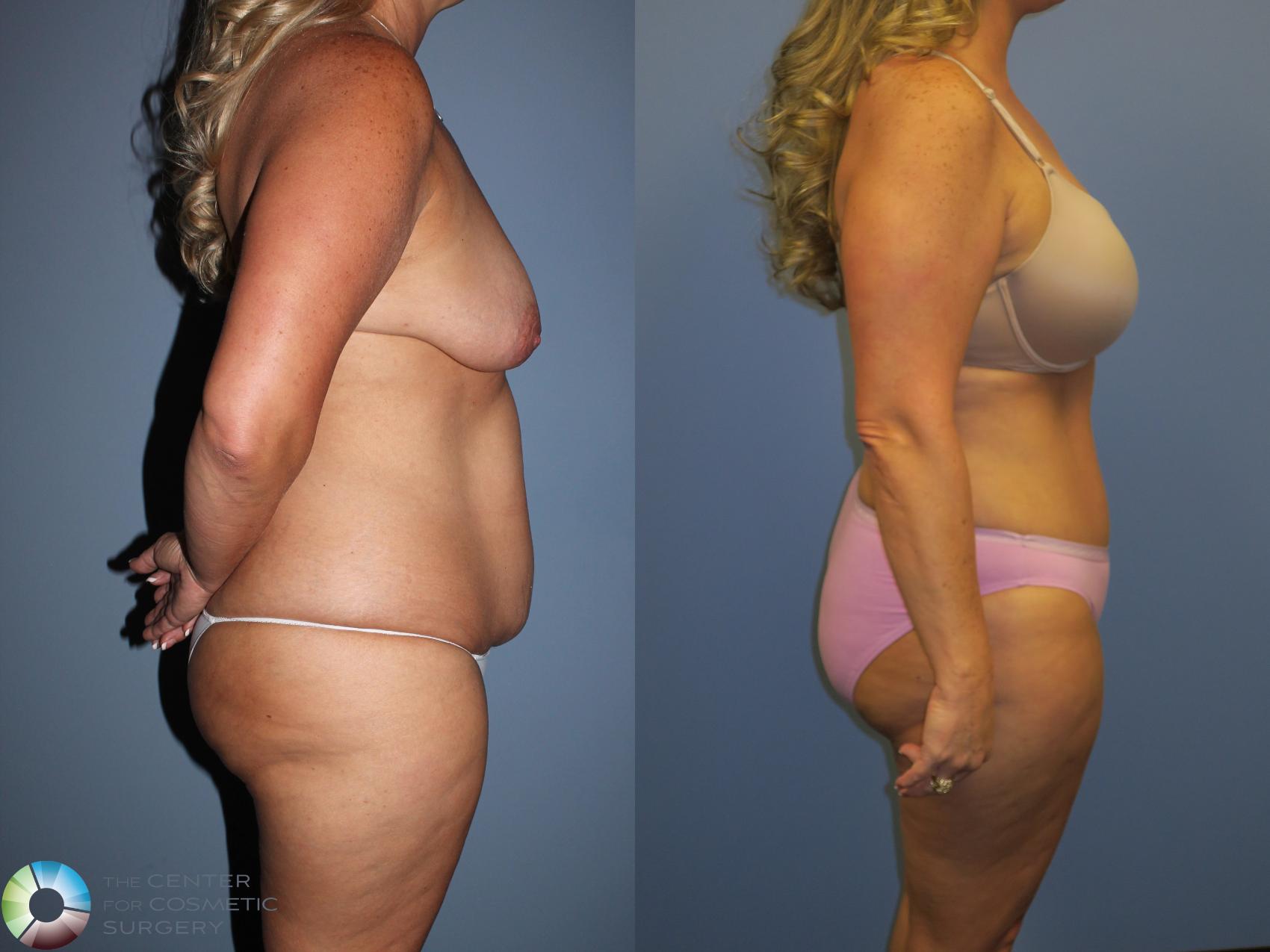 Before & After Tummy Tuck Case 11397 Right Side View in Golden, CO