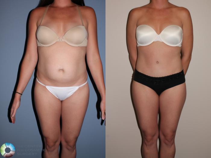 Before & After Tummy Tuck Case 11398 Front View in Golden, CO