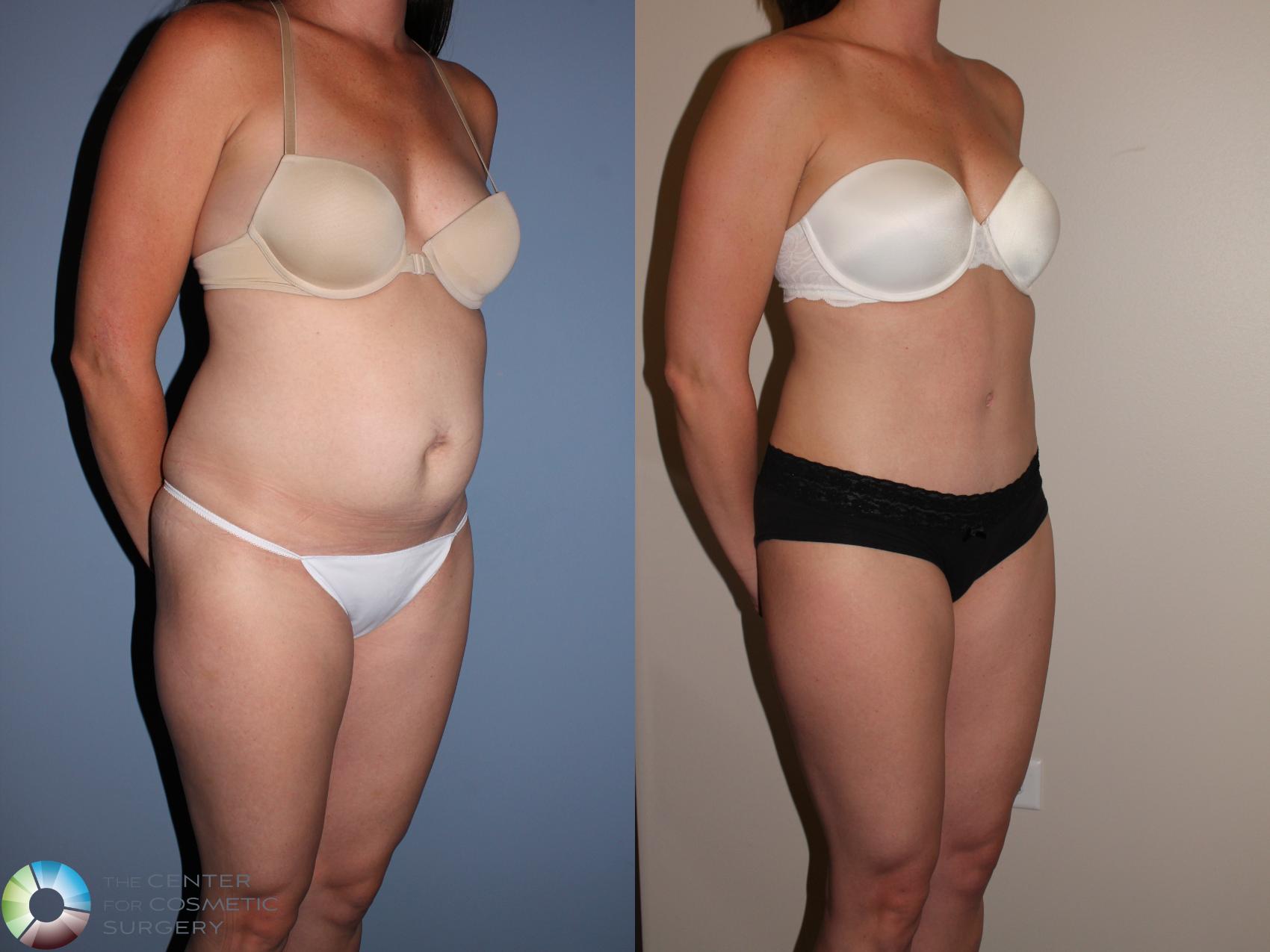 Before & After Tummy Tuck Case 11398 Right Oblique in Denver and Colorado Springs, CO