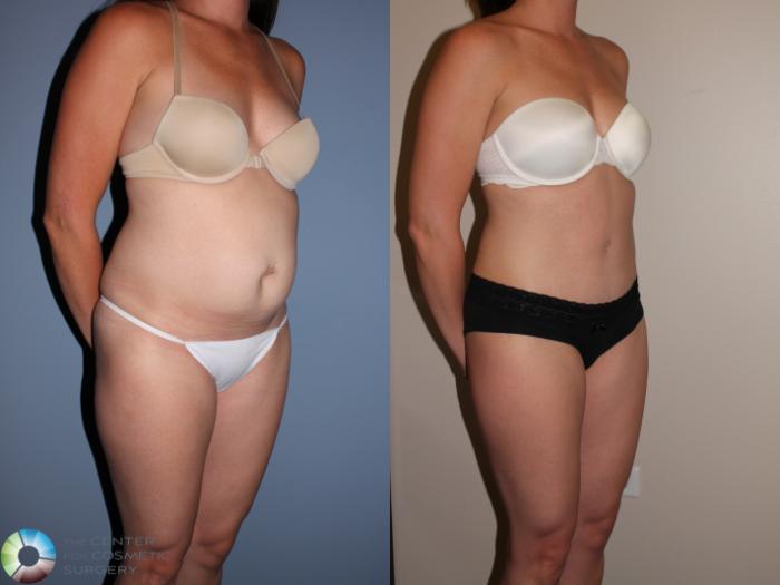 Before & After Tummy Tuck Case 11398 Right Oblique View in Golden, CO