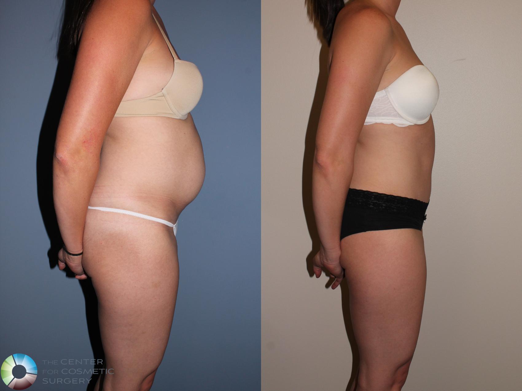 Before & After Tummy Tuck Case 11398 Right Side View in Golden, CO