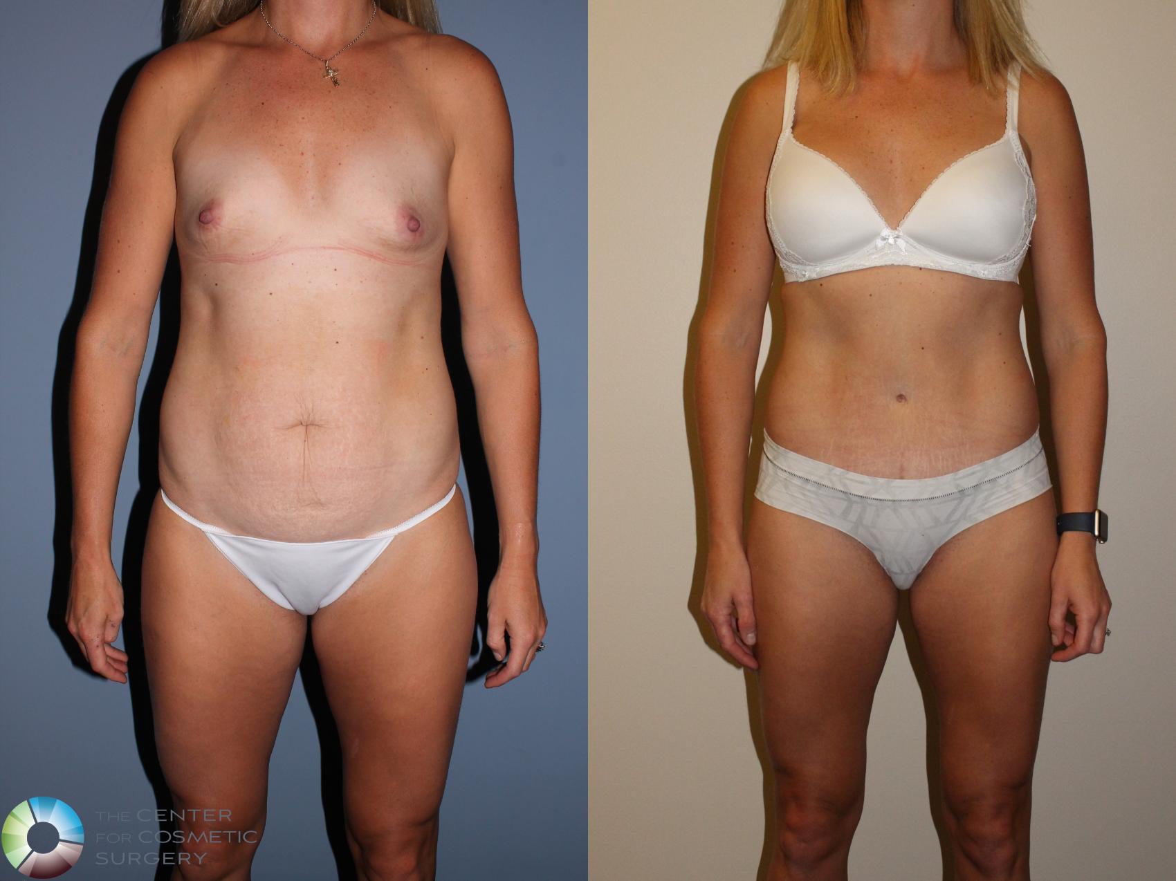 Before & After Tummy Tuck Case 11399 Front View in Denver & Golden, CO