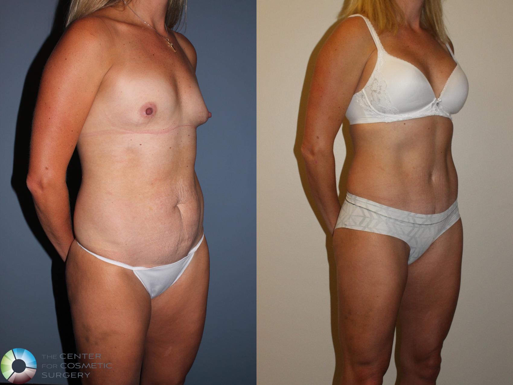 Before & After Tummy Tuck Case 11399 Right Oblique View in Denver & Golden, CO