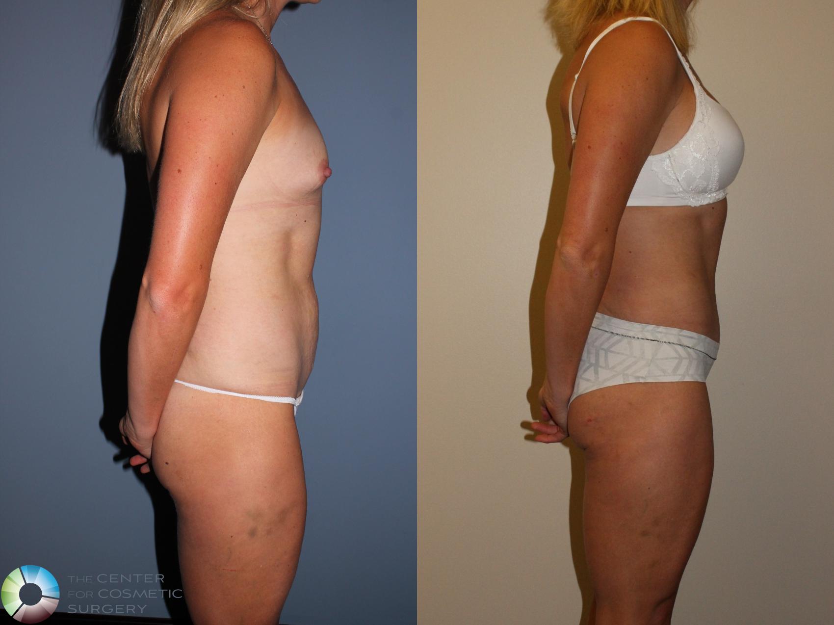 Before & After Tummy Tuck Case 11399 Right Side View in Denver & Golden, CO