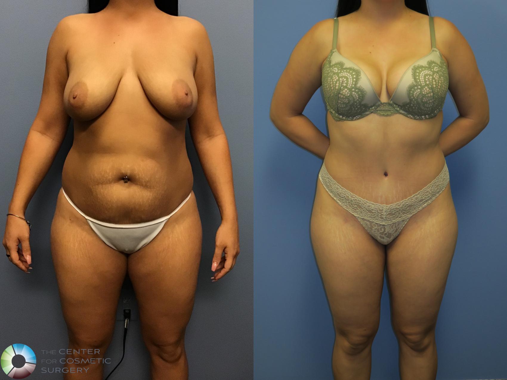 Before & After Tummy Tuck Case 11400 Front View in Denver & Golden, CO