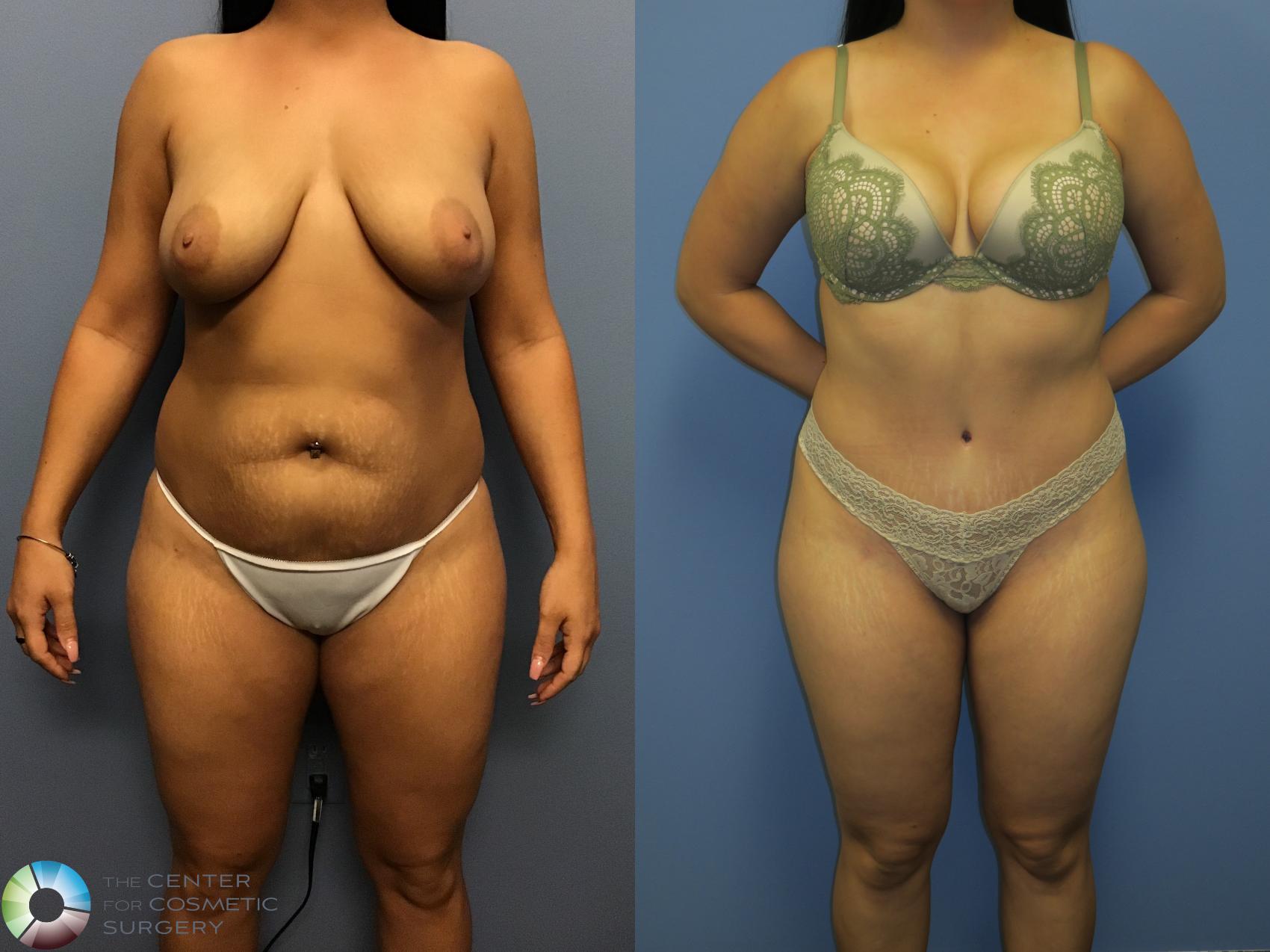 Before & After Tummy Tuck Case 11400 Front in Denver and Colorado Springs, CO